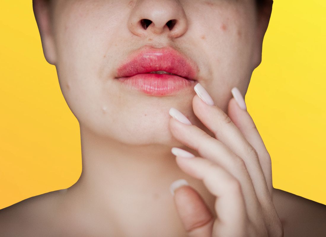 prikaz devojke sa ispucalim usnama, žuta pozadia